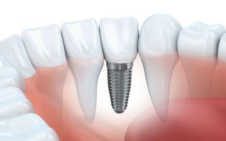 Discussing Dental Implants In Fairfield County CT With Your Family Dentist