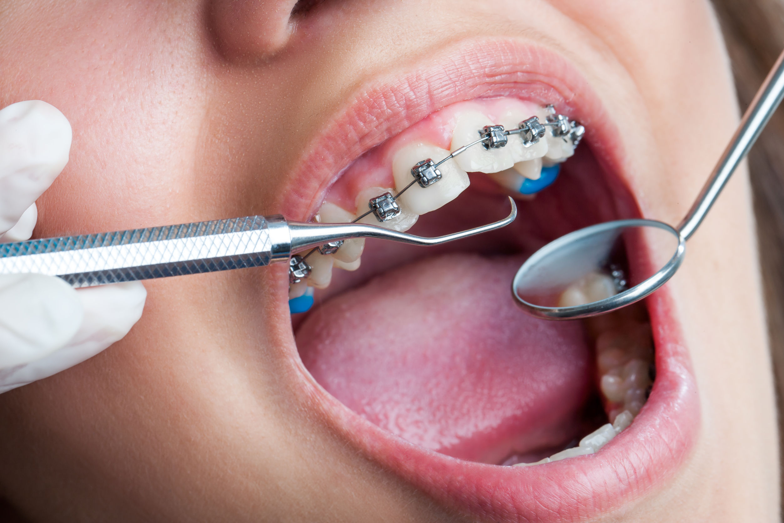 Want Healthier & Straighter Teeth? Choose An Orthodontics In Medina OH Expert